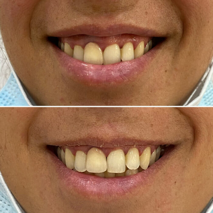 sonrisa gingival barcelona