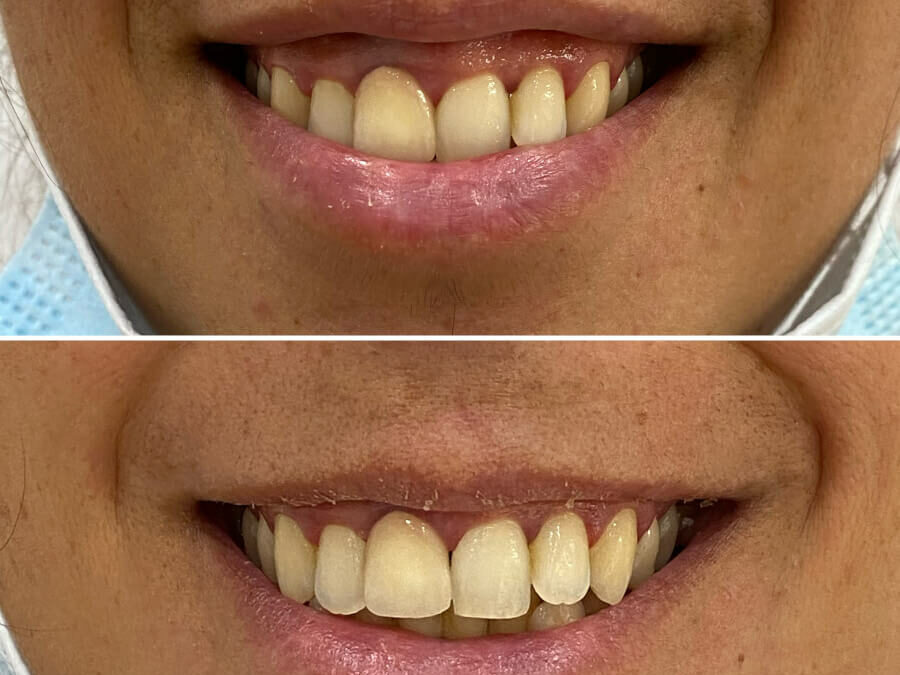 Sonrisa Gingival