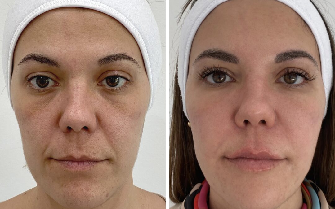 Armonización facial