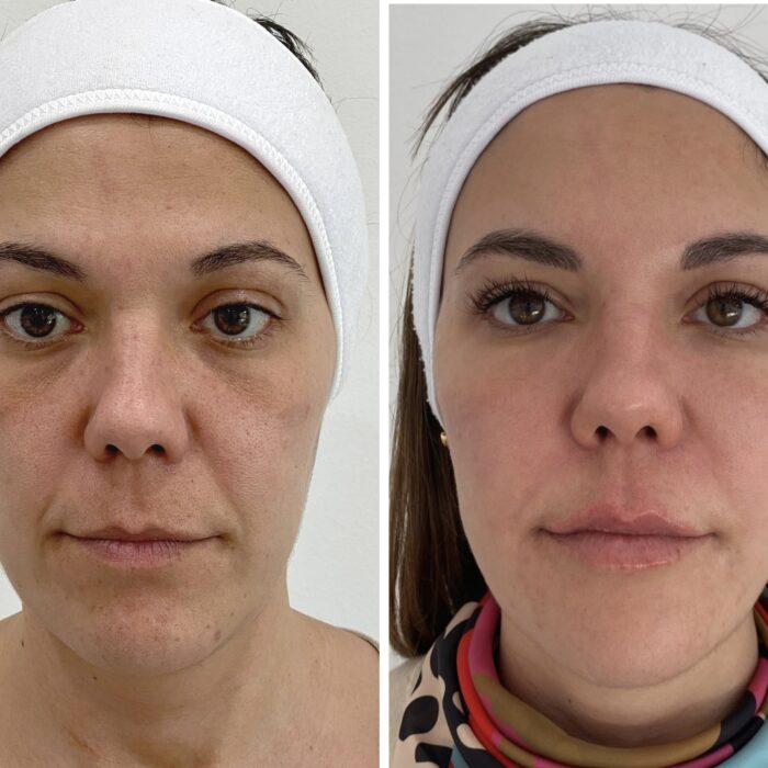 Armonización facial