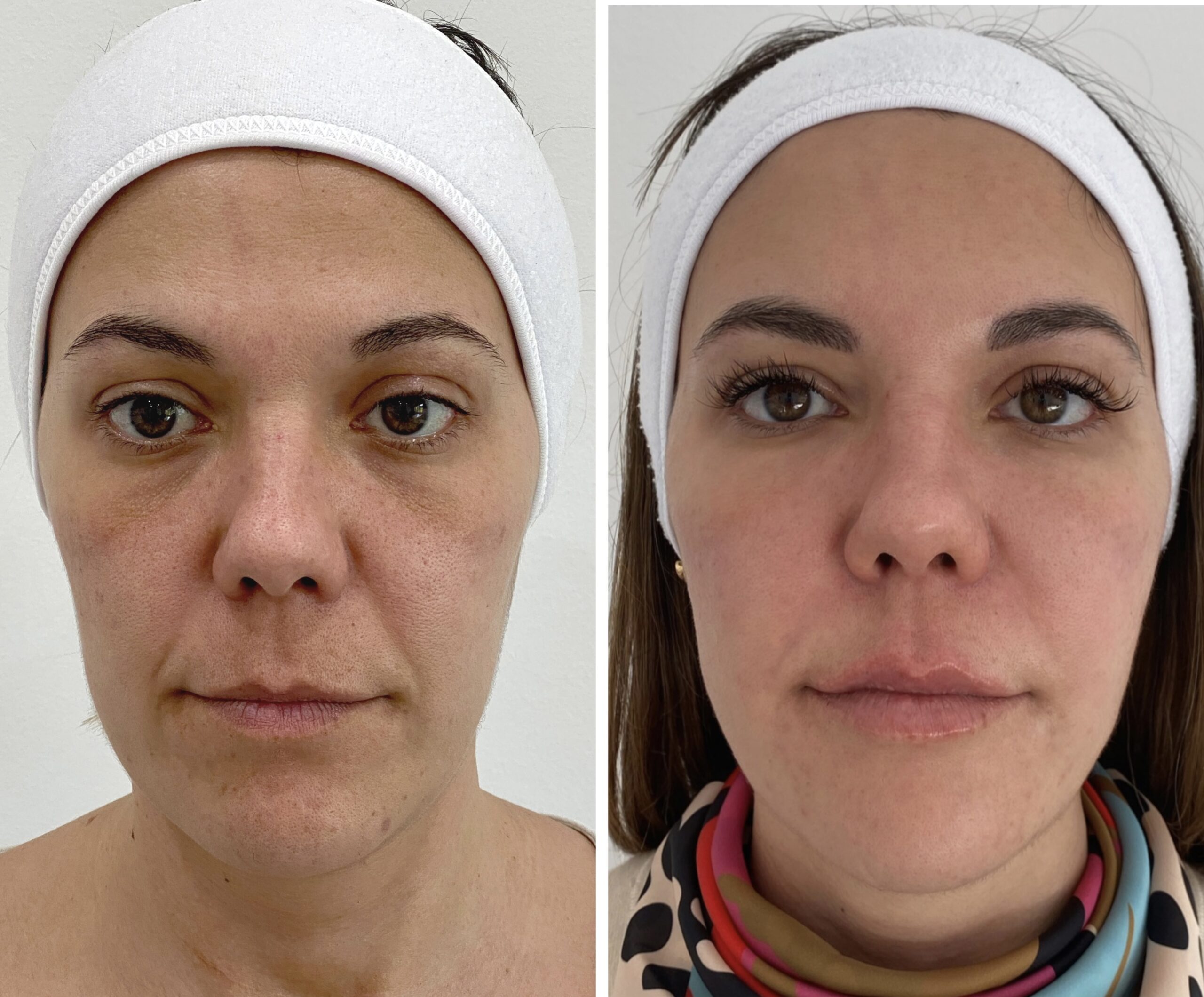 Armonización facial