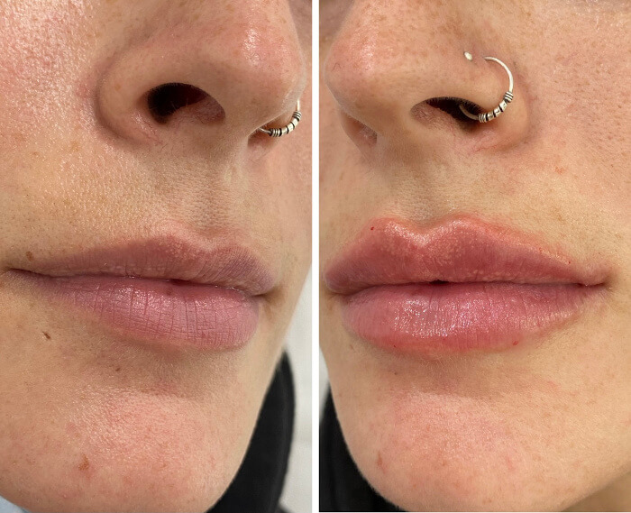 Aumento de labios