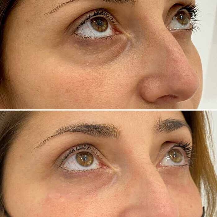 Tratamiento de ojeras con ácido hialurónico en Barcelona - Antes y después