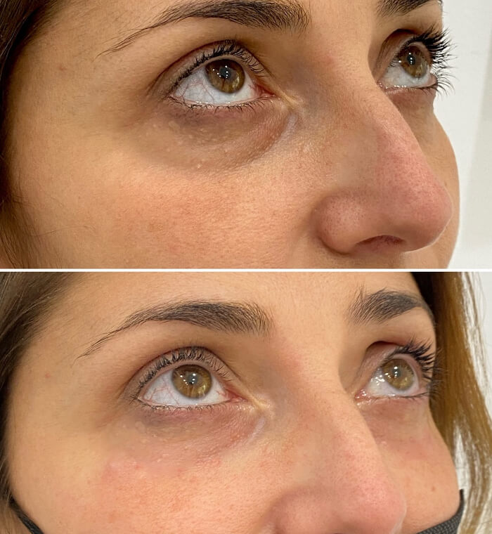 Tratamiento de ojeras con ácido hialurónico en Barcelona - Antes y después