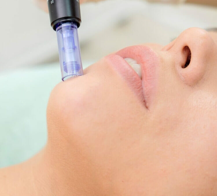 Microneedling