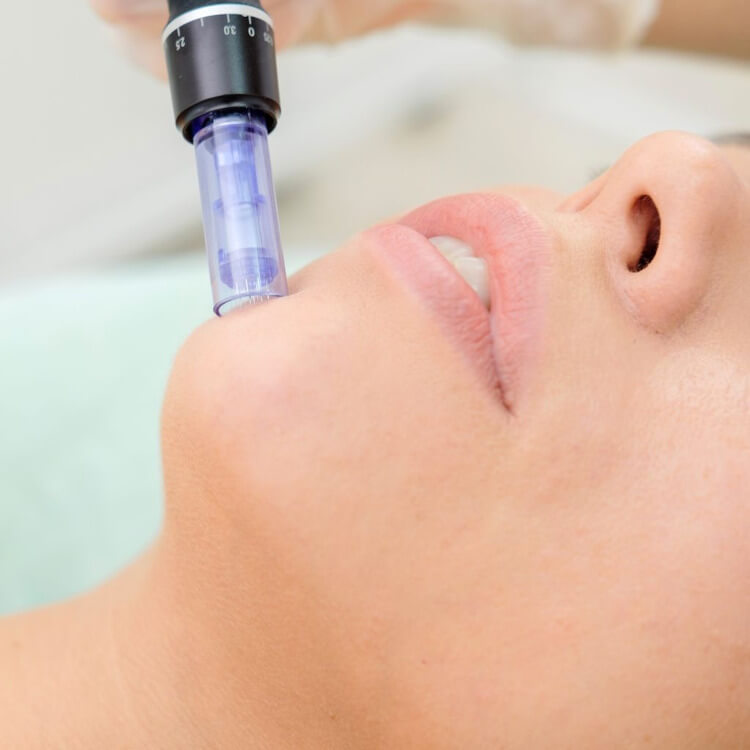 tratamiento microneedling barcelona