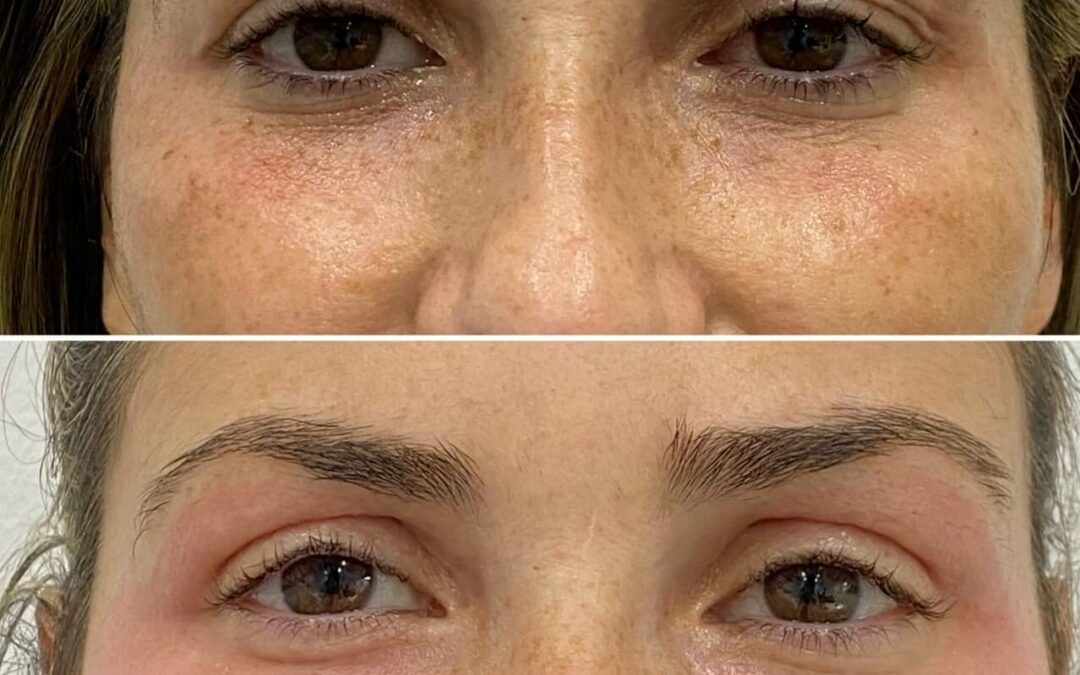 Blefaroplastia sin círugia | Plexr